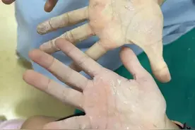 南宁两个孩子遭恶作剧，手掌被502胶牢牢粘住！医生一个办法成功解救图片