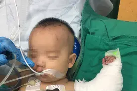 三个月大孩子断了胳膊，这是医生见过全国最小的不全断臂患者图片