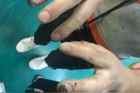 杭州烧伤女孩妈妈还原事发经过 砰的一声都是火光，我徒手抱走全身着火的女儿图片