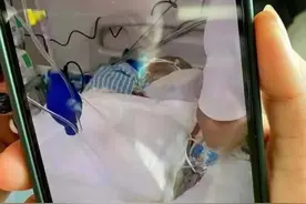 烧伤女孩被下三次病危通知，妈妈哭着还原事发瞬间：砰的一声，前面都是火光图片