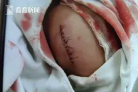 5岁男童学游泳下巴缝13针 教练：领导不同意赔钱图片