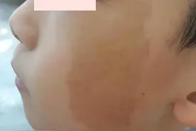 商洛4岁娃在诊所花费万余元去胎记失败，家属要求退费无果图片