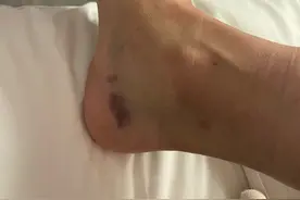 袁咏琳脚踝扭伤导致距腓前韧带撕裂 晒受伤照称第一次做手术有点小紧张图片