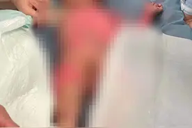 1岁男童不慎跌进开水锅 数十万治疗费急哭母亲：“求大家帮帮我们！”图片