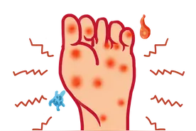 别拿“脚气”不当回事儿！有脚气要做好这10件事图片