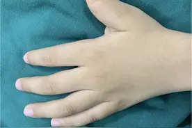 多指不是“聪明指”别给孩子徒增童年烦恼图片