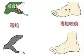 抓蛇玩耍被咬伤 9岁男孩全身多处瘀斑被送进ICU图片