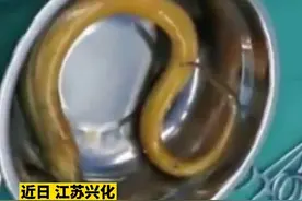 男子为治便秘将黄鳝塞进肛门，穿破直肠命悬一线图片