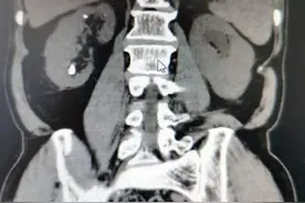 兰大二院泌尿外科成功开展院内首例去管化超微经皮肾镜碎石取石术（Tubeless SMP）图片
