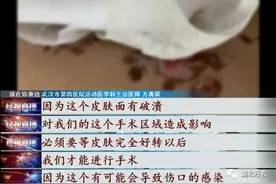 冰与干冰，一字之差！小伙选错致膝伤“雪上加霜”，皮肤起水泡，医生提醒…图片