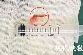 瓜子壳戳破2岁男童直肠，两个月后才取出来图片