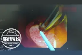男子体内发现很多寄生虫，医生：和饮食习惯有关图片