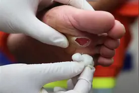 心疼！支援河南的东营消防员双脚泡皱发白，脚底磨出血泡图片