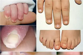 这里有一份儿童甲病大全，你认识几个？图片