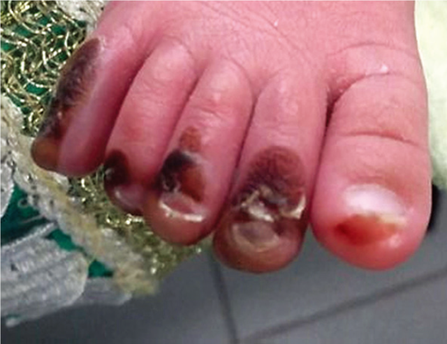 湿锐疣图片大全 疣图片大全