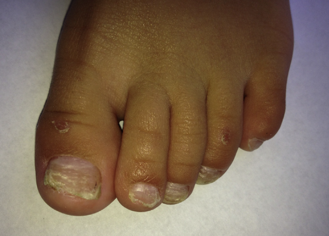 湿锐疣图片大全 疣图片大全