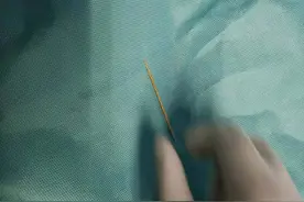 长沙小伙含着牙签喝水，一不小心吞进肚里致胃穿孔图片