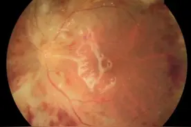 浙江一大伯视力突然下降，感觉左眼像“瞎”了！得过这些病的人要注意了图片