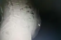 自行针灸，不料针断腹中图片