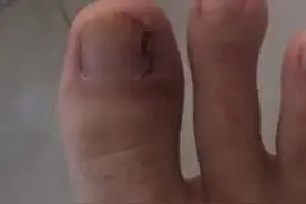 有一种痛，叫得了“甲沟炎”的痛图片