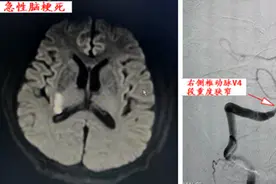【医疗动态】脑病介入科开展颅内血管再通手术图片