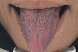 当心！3种舌象，可能提示甲状腺疾病图片