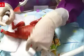 23周+4天！创佛山记录！顺德超早早产儿“巴掌宝宝”生命闯关图片