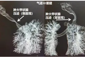 胸闷气短一个多月，原来是这里出了问题，手术后 75岁奶奶说：我第一次呼吸这么畅快图片