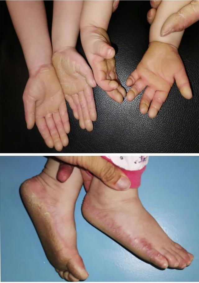 掌指角化