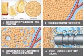 吸脂以后没变瘦，还出现了这些吸脂后遗症怎么办？图片