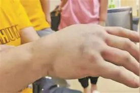 女娃手指被门夹断 警惕假期意外伤图片