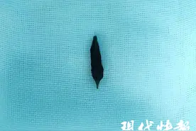 2岁女童肛门反复流脓，“真凶”竟然是一粒枣核图片