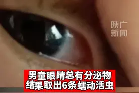 慎点！2岁男童眼睛总有分泌物，结果取出6条蠕动活虫图片