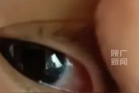 慎点！2岁男童眼睛总有分泌物，结果取出6条蠕动活虫图片