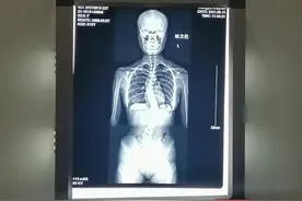 15岁少女弯腰驼背 被诊断为脊柱侧弯 这些不良习惯要改图片