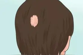 斑秃是什么原因引起的？该怎么治疗？图片