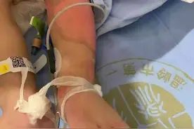 痛心！浙江1岁男娃特重度烫伤，仍在ICU抢救！奶奶哭成泪人：都怪我图片