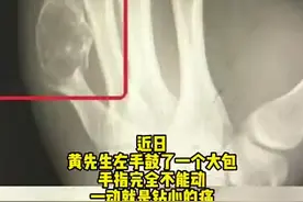 程序员左手酸疼7年查出骨肿瘤：以为就是“键盘手”没在意图片