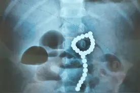 又是它！4岁孩童以为是糖，一口气吞下26颗图片