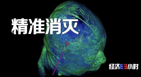 重大利好！不开颅治疗脑肿瘤，费用预计为国外的5%