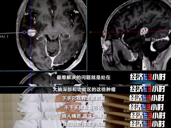 重大利好！不开颅治疗脑肿瘤，费用预计为国外的5%