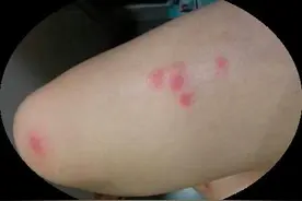 夏天睡凉席，身上发痒过敏是怎么回事？图片