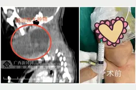 气管插管惊险10分钟 广西一颈部巨大肿瘤胎儿手术获救图片