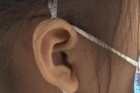 女童睡梦痛醒，耳中竟取出活物！近期多发，预防有妙招图片