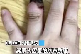 创可贴别乱用！家人错误包扎致3岁女童手指坏死，网友：心疼图片