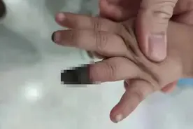 痛心！3岁女童小伤却被截掉手指！只因做错了这件事图片
