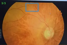 一觉醒来“瞎”了！眼睛也会“中风”图片