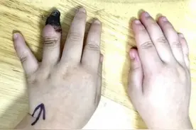 错误包扎致3岁女童手指坏死 你真的懂如何包扎伤口吗？图片