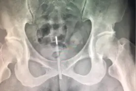 为寻求刺激，29岁小伙将体温计塞进尿道，结果体温计断裂牢牢卡在尿道图片