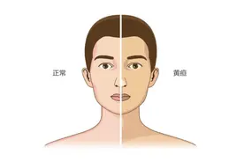 黄疸是怎么回事？不只是皮肤有点“黄”图片
